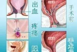 女性混合痔疮手术视频,女性混合痔疮手术过程解析与康复指导